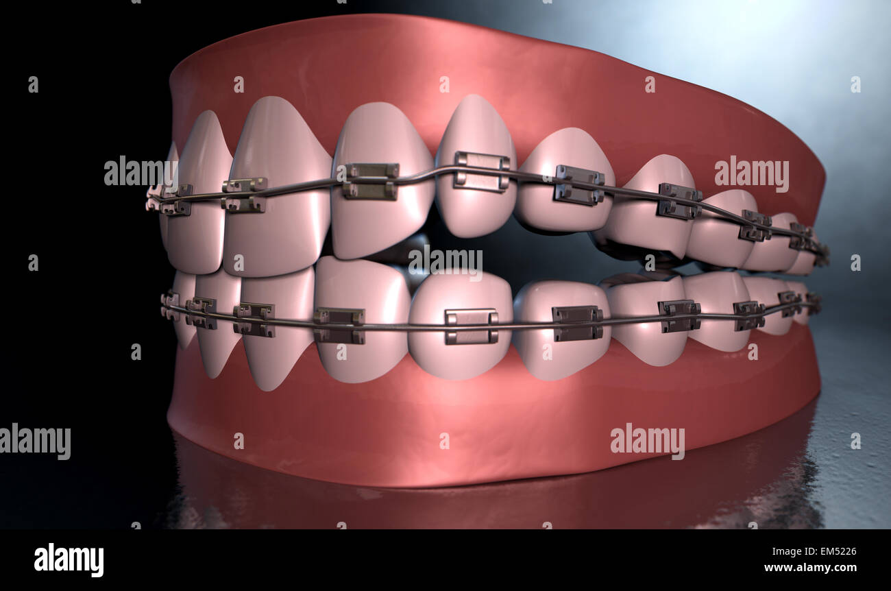 Une sinistre représentation spectaculaire de supérieur et inférieur séparés ensembles de dents humaines à bretelles qui leur sont appliquées sur un étrange sombre spotl Banque D'Images