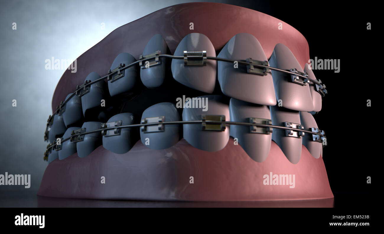 Une sinistre représentation spectaculaire de supérieur et inférieur séparés ensembles de dents humaines à bretelles qui leur sont appliquées sur un étrange sombre spotl Banque D'Images