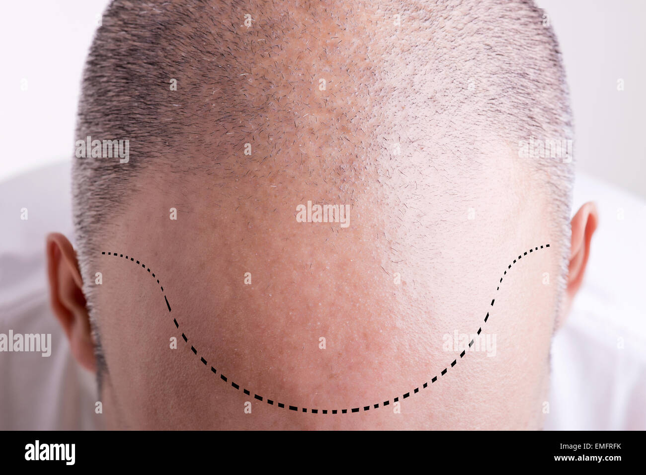 Vue de dessus d'une tête d'hommes avec une ligne de cheveux de recul Banque D'Images