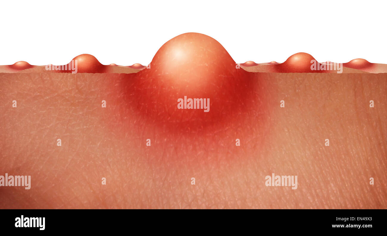 Concept de soins de santé de peau d'Acné comme un groupe de boutons ou des plaies sur la peau humaine comme une anatomie symbole pour un épiderme soin Banque D'Images