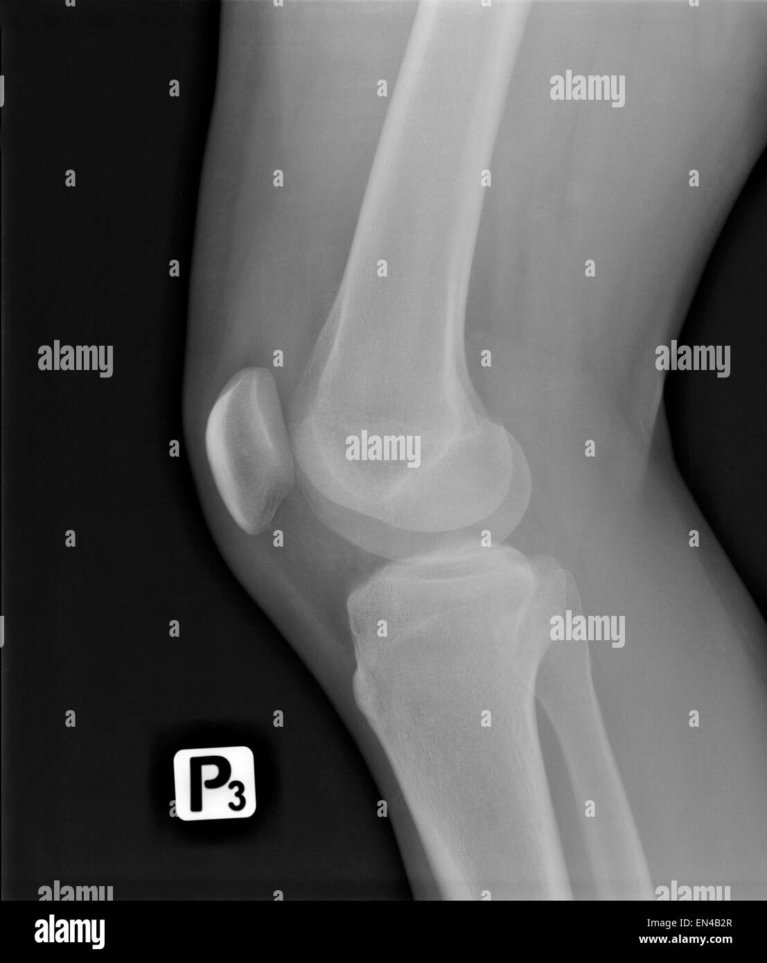 X-ray image numérisée radiologie jeune homme de blessure à la jambe Banque D'Images
