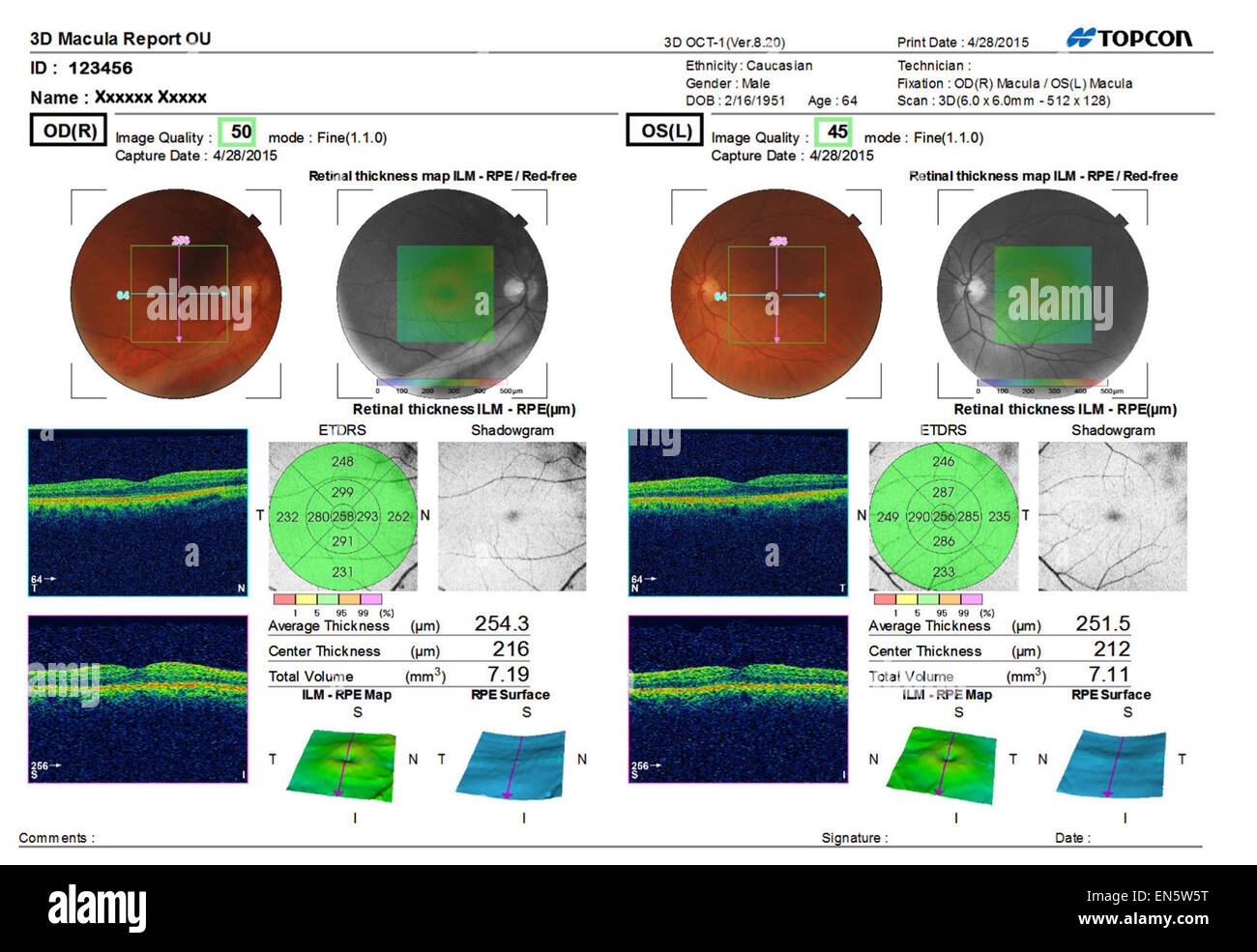 Eye test sonore ultra numérisation 3D montrant MACULA Rapport de l'œil
