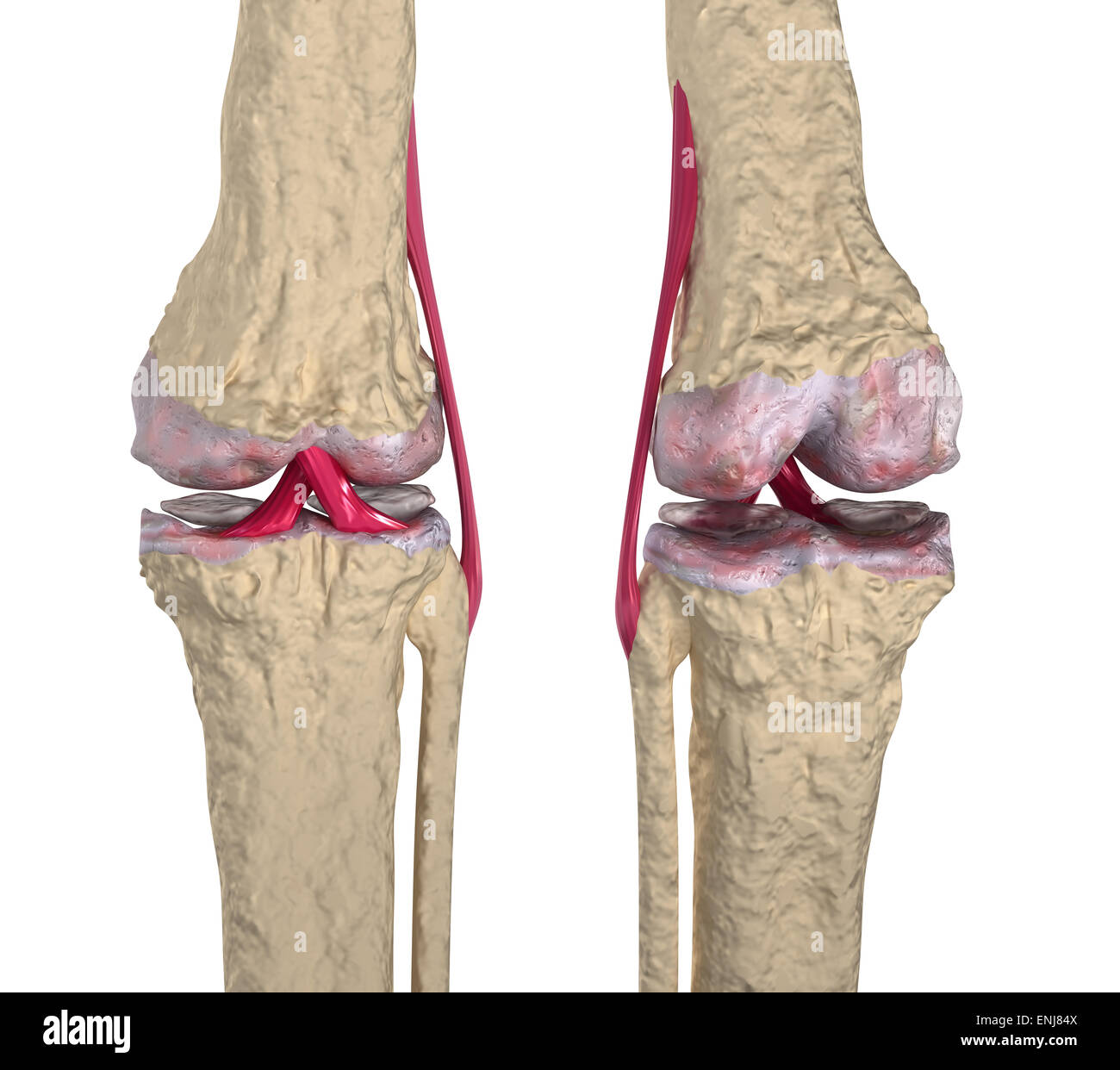 L'arthrose : articulation du genou avec des ligaments et des cartilages Banque D'Images