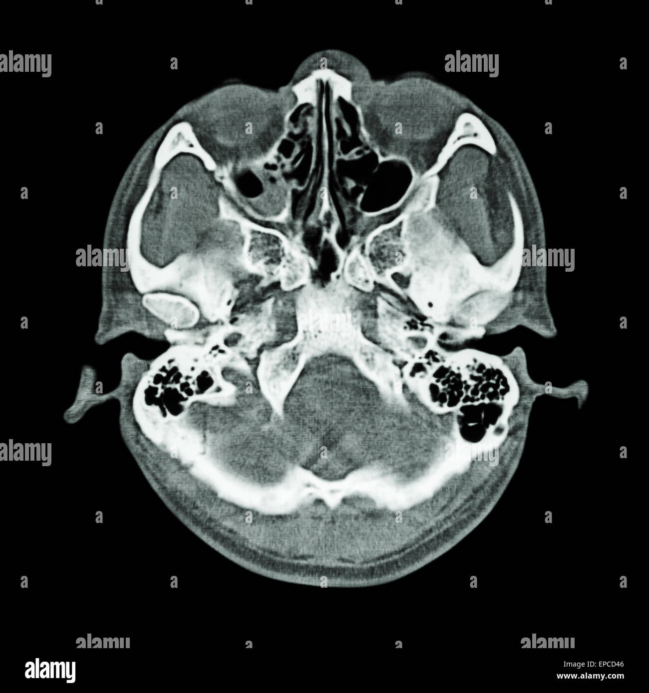 Scanographie du cerveau et du crâne de base ( Bone ) Banque D'Images
