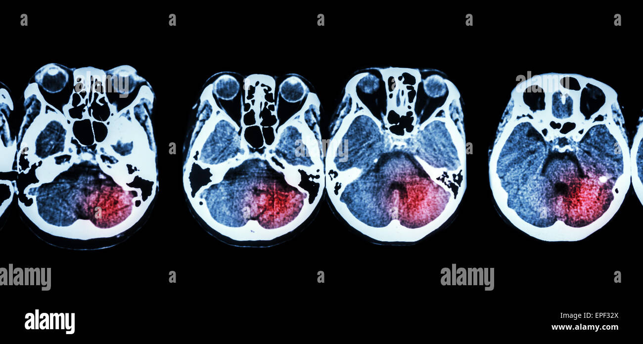 ( CT scan de cerveau et la base du crâne et l'accident vasculaire cérébral ) Banque D'Images