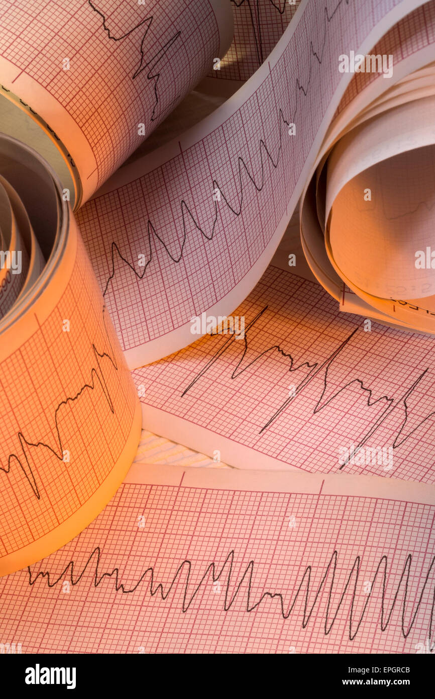 Des traces d'électrocardiographe l'arythmie cardiaque, y compris la fibrillation ventriculaire (FV) et la tachycardie ventriculaire (TV). Banque D'Images