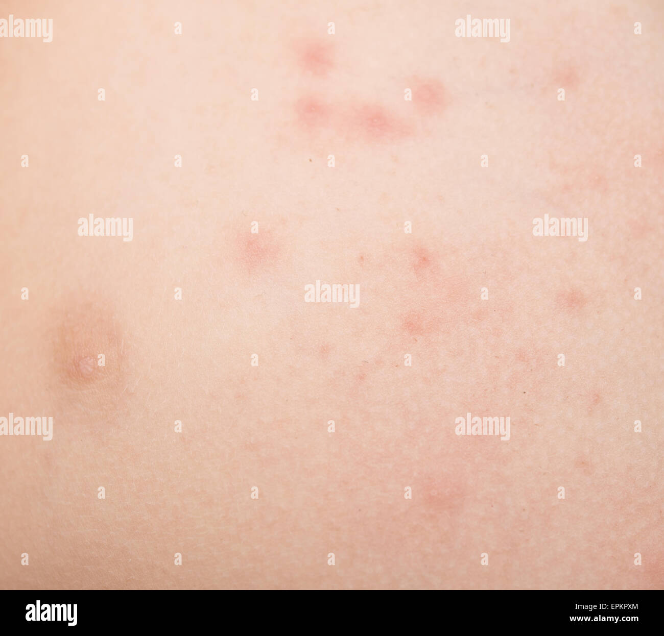 Eruption Cutanee Photo Stock Alamy