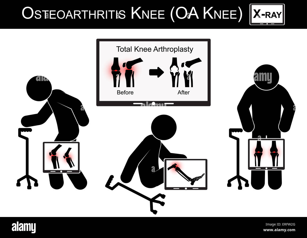 Vieil homme la douleur à son genou , Moniteur show image d'arthroplastie totale du genou ( avant et après traitement chirurgical de l'arthrose ) Banque D'Images