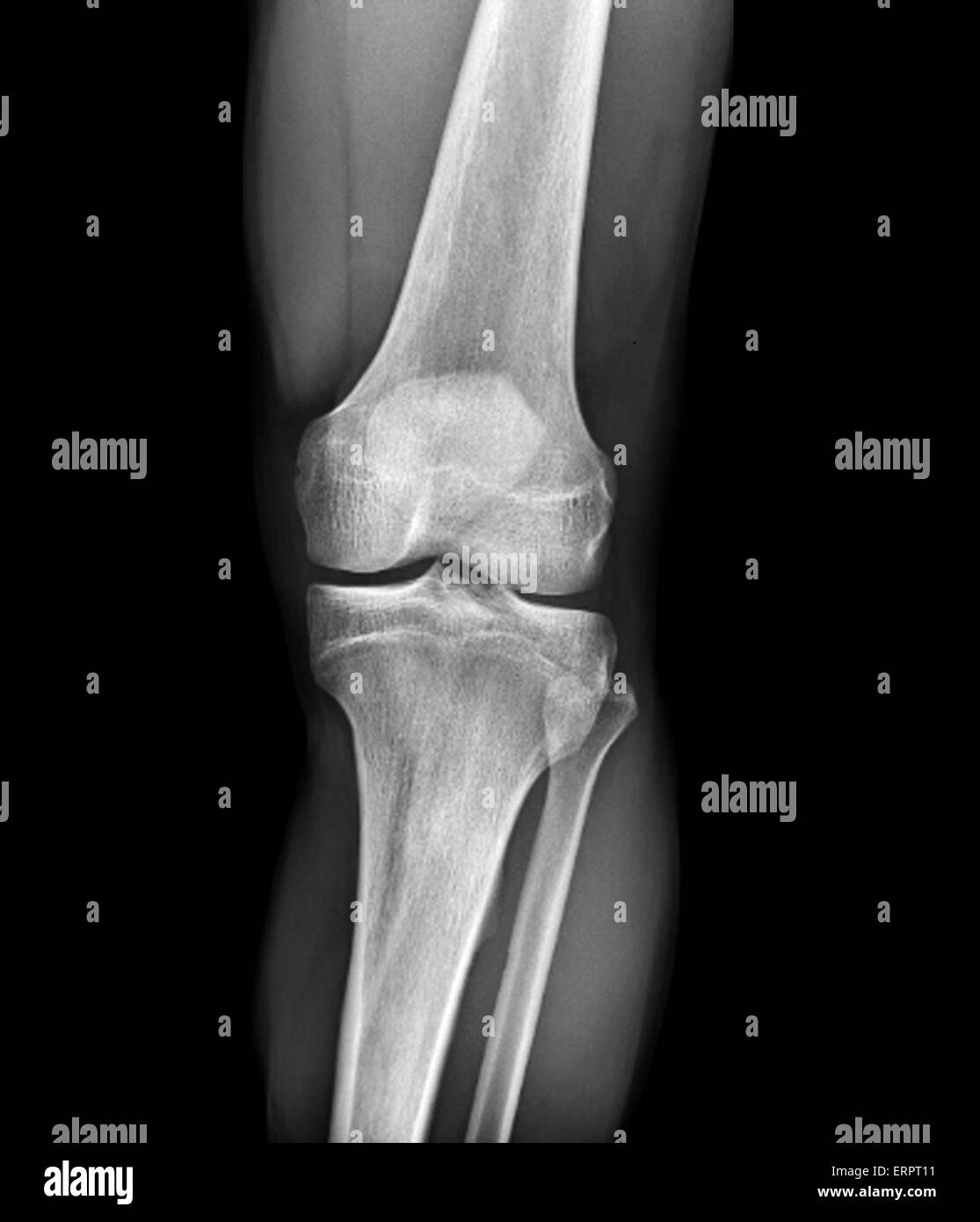 Radiographie d'une articulation du genou Banque de photographies et  d'images à haute résolution - Alamy