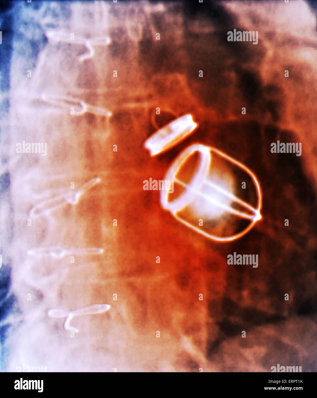 Valves cardiaques artificielles. X-ray de couleur de la poitrine d'un patient de 59 ans avec une insuffisance cardiaque qui a eu à la fois la valve mitrale et aortique de leur coeur remplacés par des valves cardiaques artificielles. Banque D'Images
