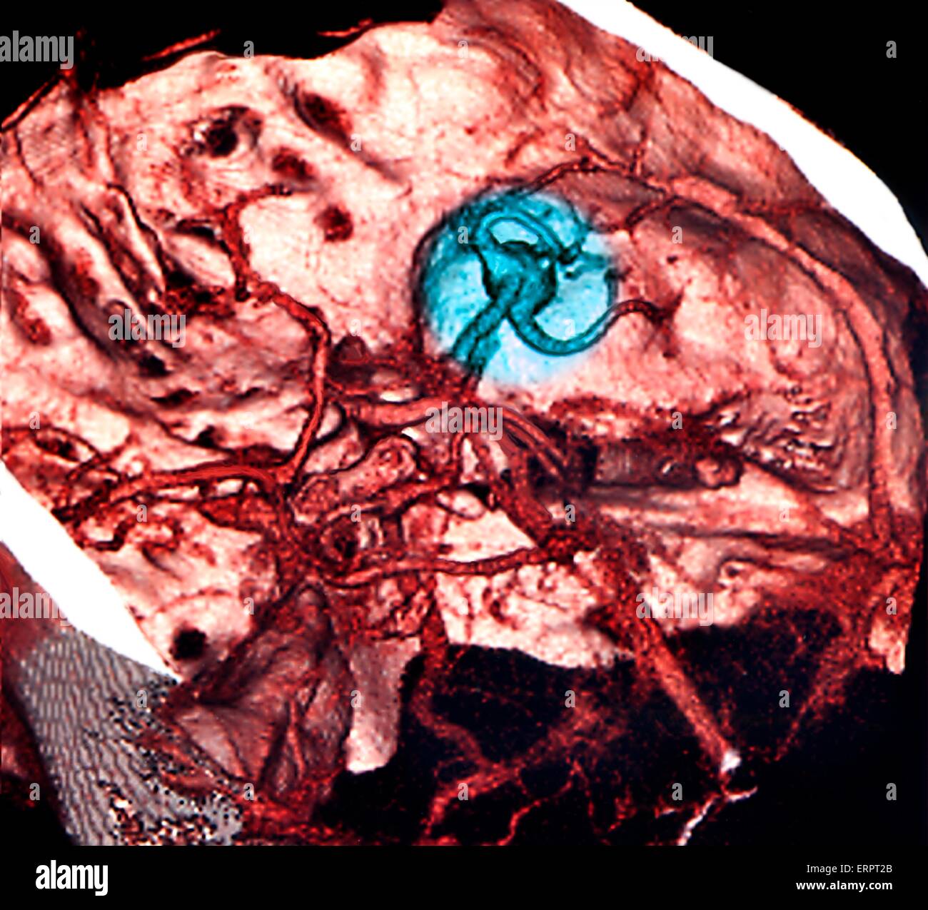 Hémorragie cérébrale. 3D couleur Scanner (CT) (CPA) du cerveau d'un patient de 42 ans avec une hémorragie sous-arachnoïdienne (HSA, bleu). SAH est le saignement dans l'espace sous-arachnoïdien - la zone située entre la membrane de l'arachnoïde et la pie-mère s Banque D'Images