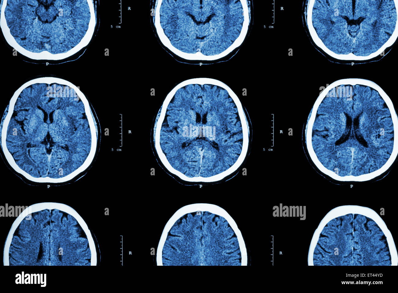 CT scan du cerveau indiquent un cerveau normal ( contexte neurologique ) Banque D'Images