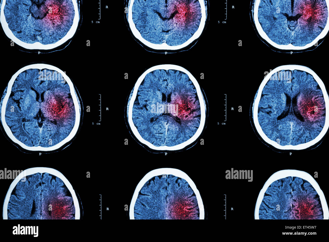 CT scan de cerveau avec zone rouge ( imagerie pour l'accident vasculaire cérébral hémorragique ou ischémique du myocarde ( AVC ) Notion ) Banque D'Images