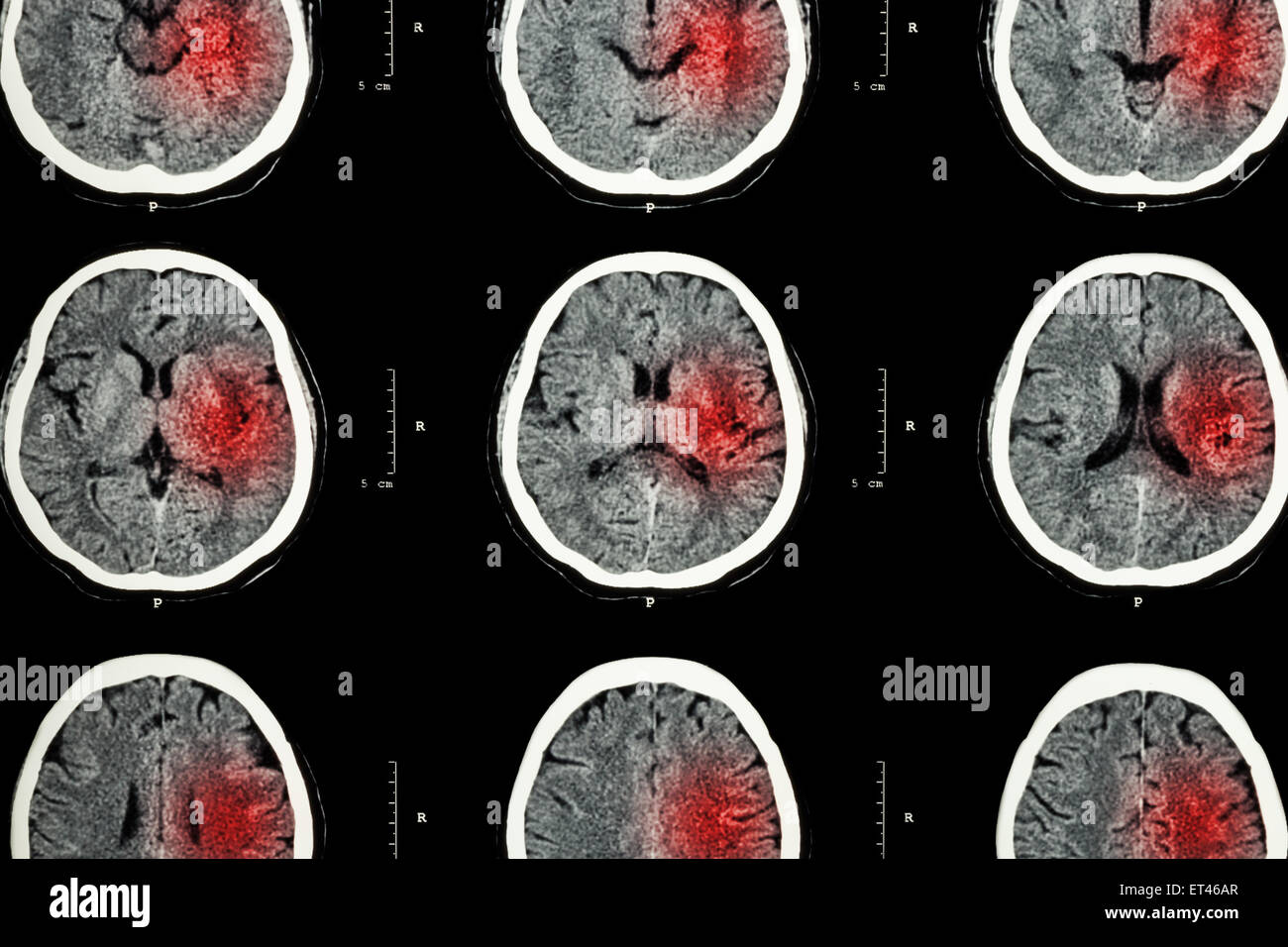 CT scan de cerveau avec zone rouge ( imagerie pour l'accident vasculaire cérébral hémorragique ou ischémique du myocarde ( AVC ) Notion ) Banque D'Images