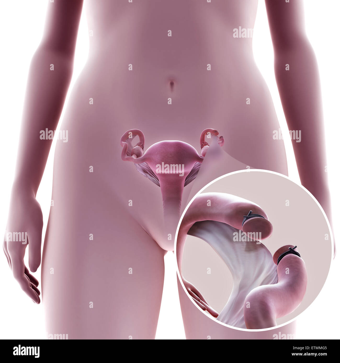 Illustration de la ligature des trompes de Fallope, la méthode par résection, où une section du tube est retiré pour empêcher la fécondation. Banque D'Images