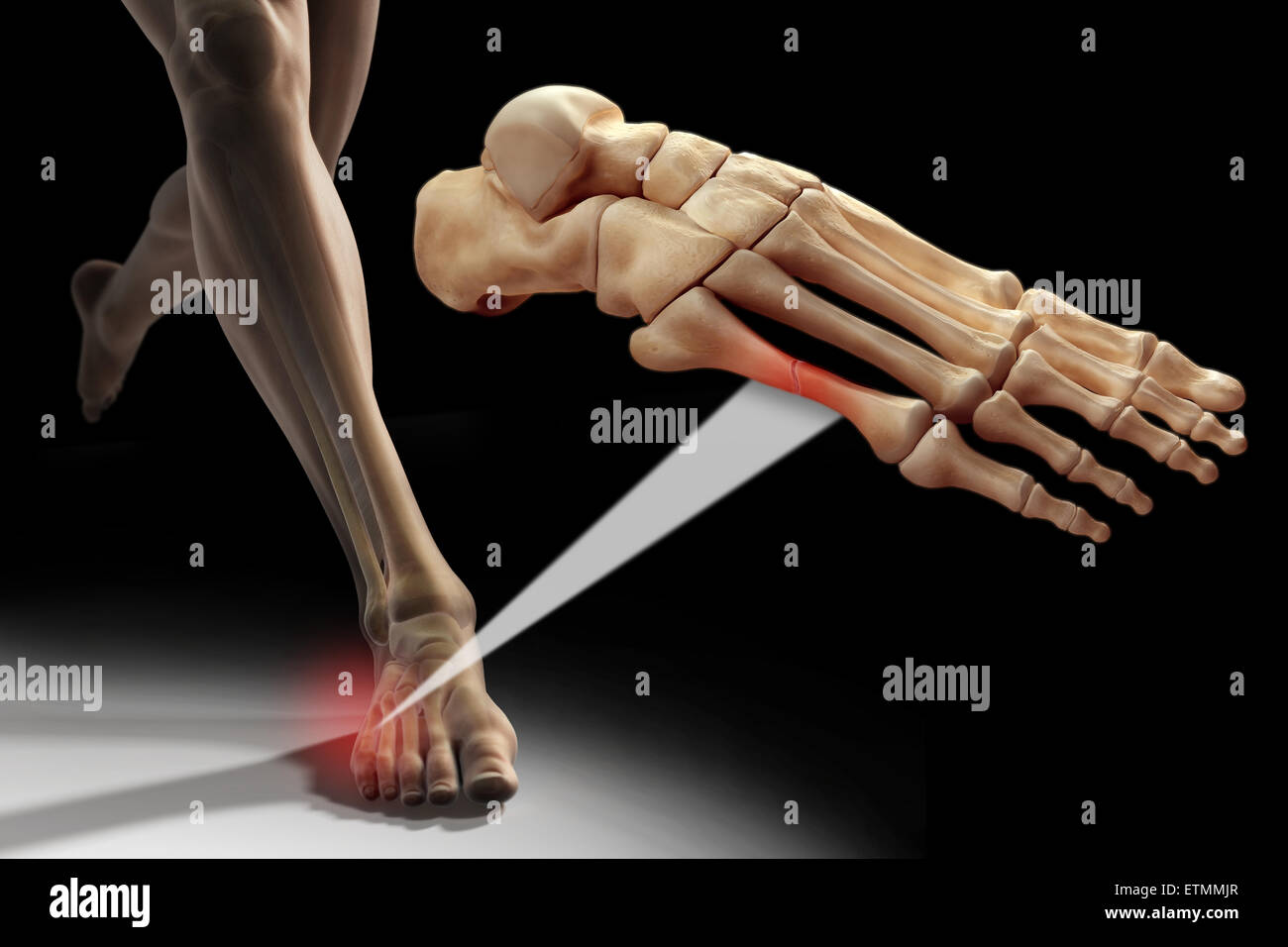 Illustration montrant une figure d'exécution avec les os du pied en surbrillance. Un zoom arrière section montre une coupure d'un métatarsien. Banque D'Images
