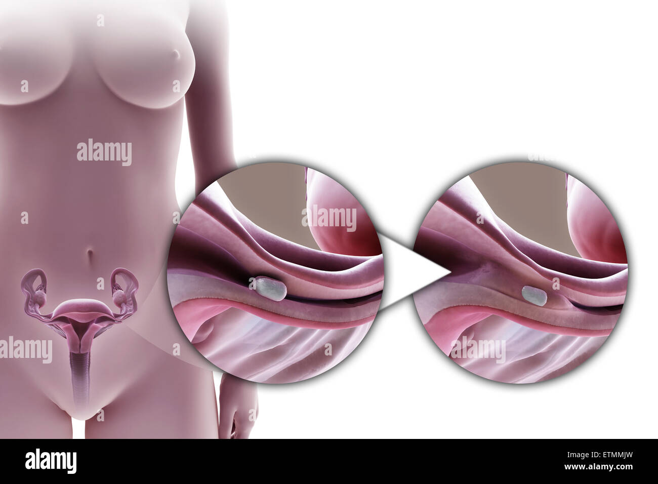 Illustration de la ligature des trompes de Fallope par la méthode d'un implant en silicone, utilisé pour bloquer le tube par la croissance de tissu cicatriciel et empêcher la fécondation. Banque D'Images