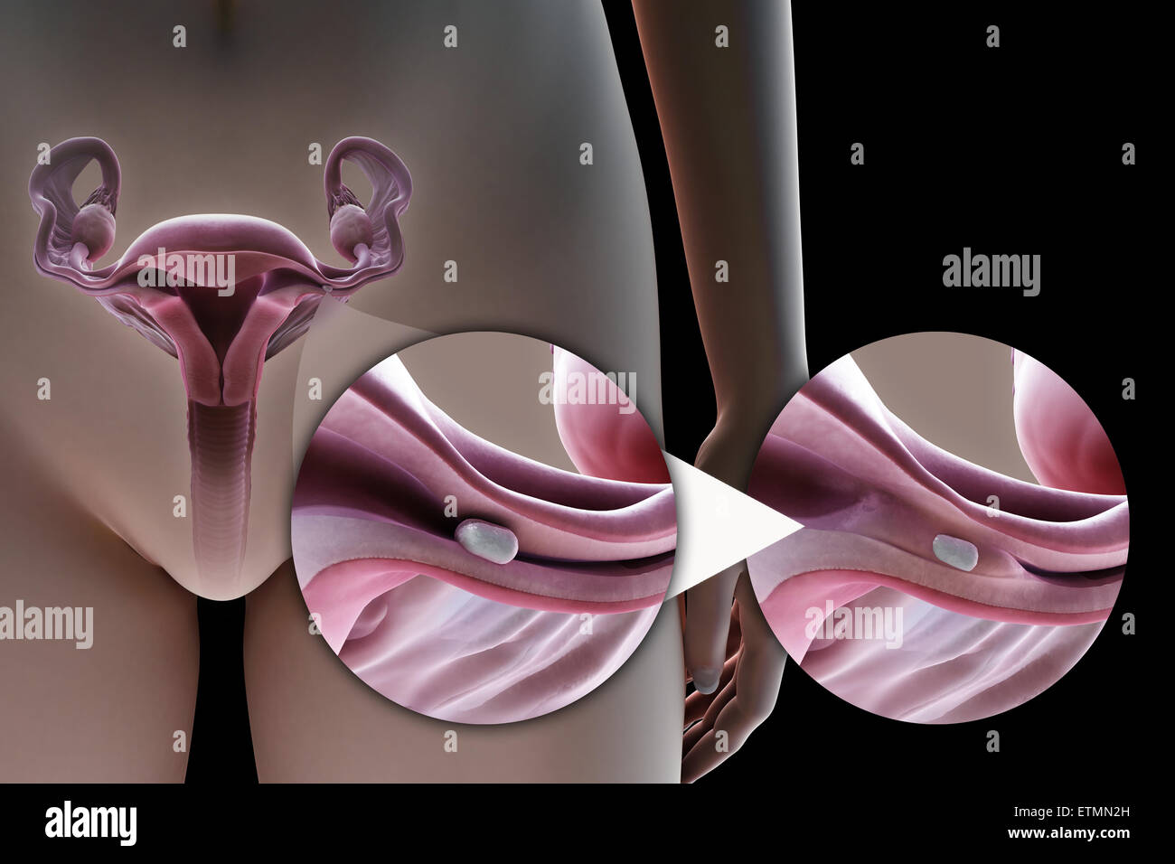 Illustration de la ligature des trompes de Fallope par la méthode d'un implant en silicone, utilisé pour bloquer le tube par la croissance de tissu cicatriciel et empêcher la fécondation. Banque D'Images