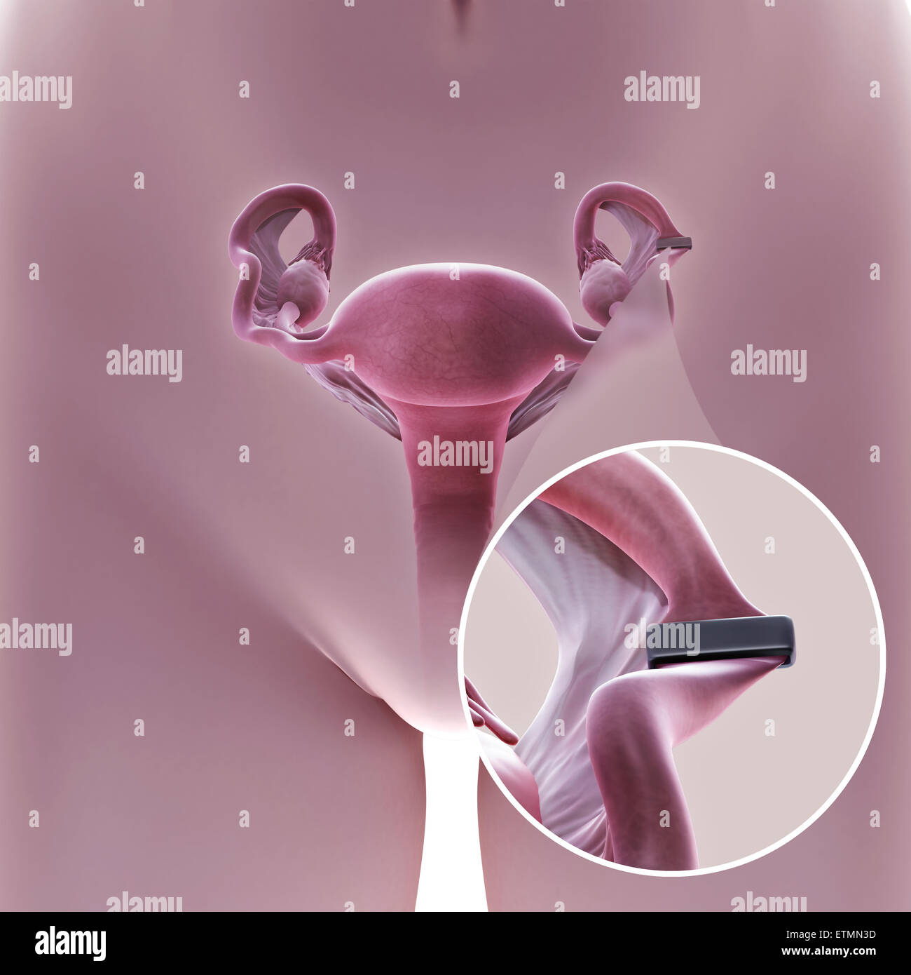 Illustration de la ligature des trompes de Fallope par la méthode d'un clip,  utilisé pour bloquer le tube et empêcher la fécondation Photo Stock - Alamy