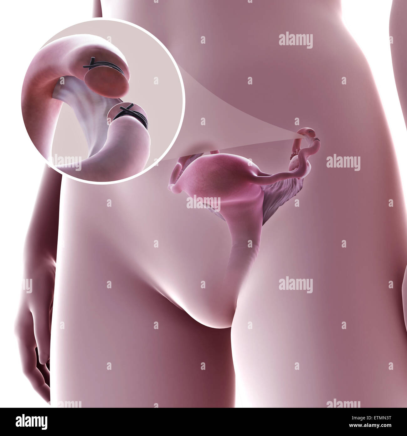 Illustration de la ligature des trompes de Fallope, la méthode par résection, où une section du tube est retiré pour empêcher la fécondation. Banque D'Images