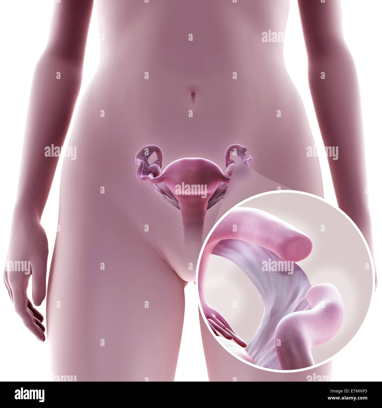 Illustration de la ligature des trompes de Fallope par la méthode de coagulation, où une section du tube est cautérisée pour empêcher la fécondation. Banque D'Images