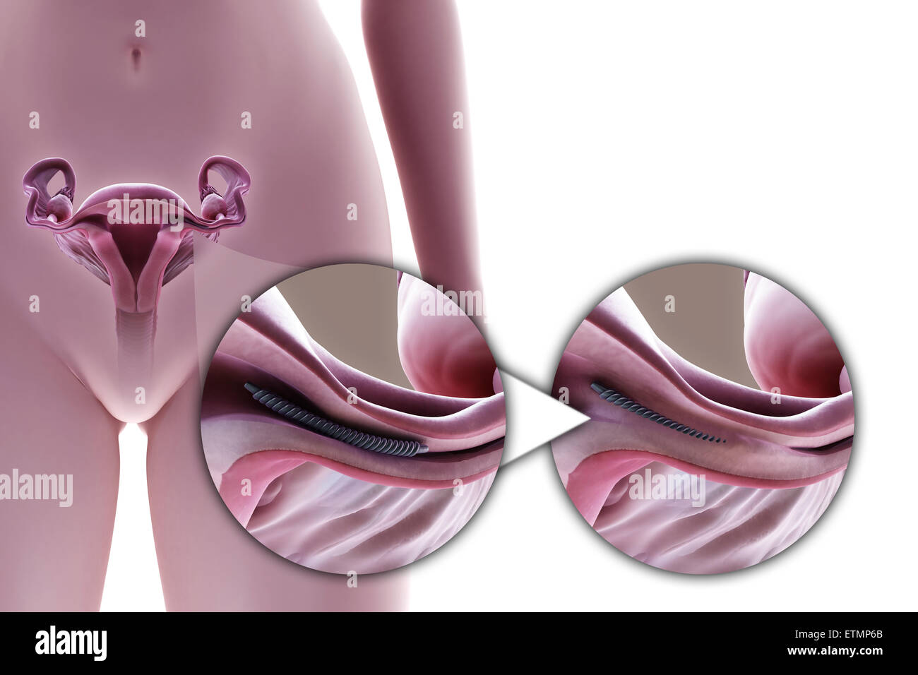 Illustration de la ligature des trompes de Fallope par la méthode d'un implant métallique, utilisé pour bloquer le tube par la croissance de tissu cicatriciel et empêcher la fécondation. Banque D'Images