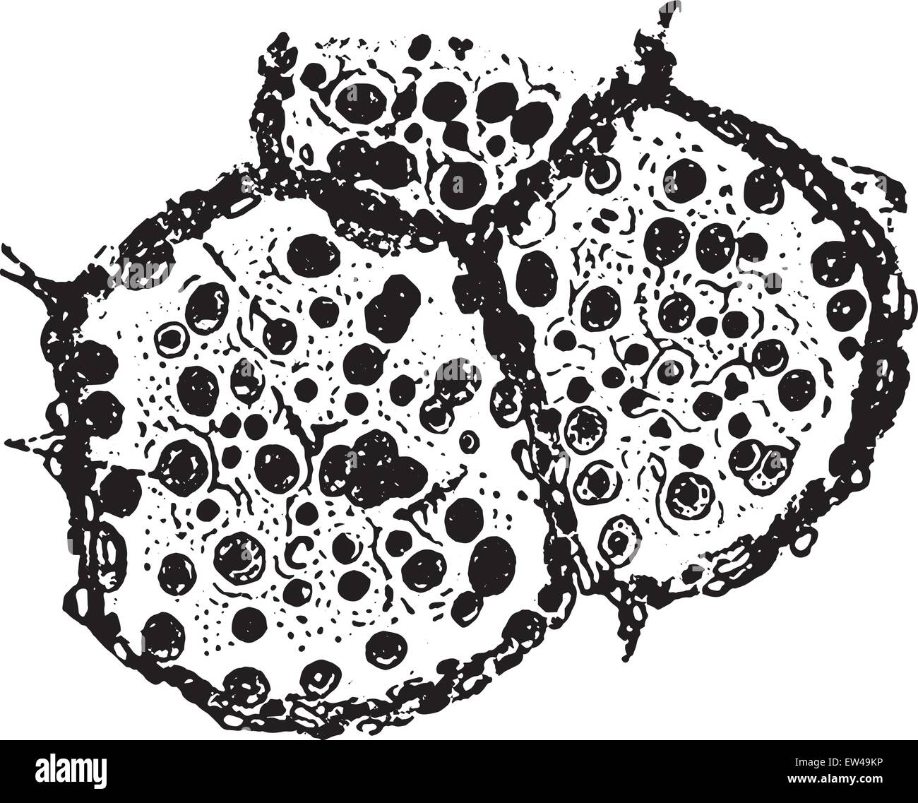 Deux alvéoles et d'une partie de poumon de tiers dans la pneumonie catarrhale, vintage engraved illustration. Illustration de Vecteur