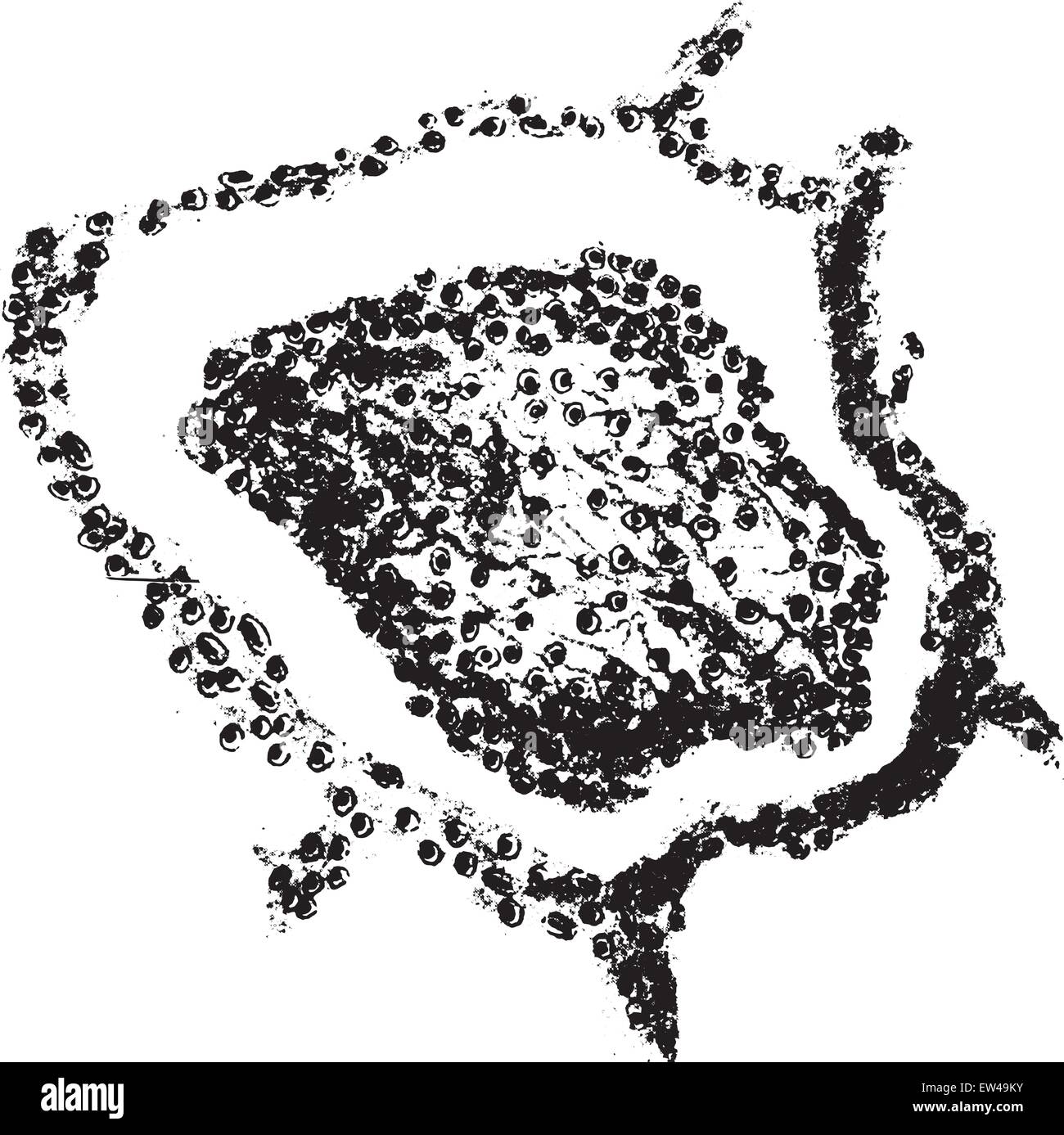 Croupous la pneumonie, vintage engraved illustration. Illustration de Vecteur
