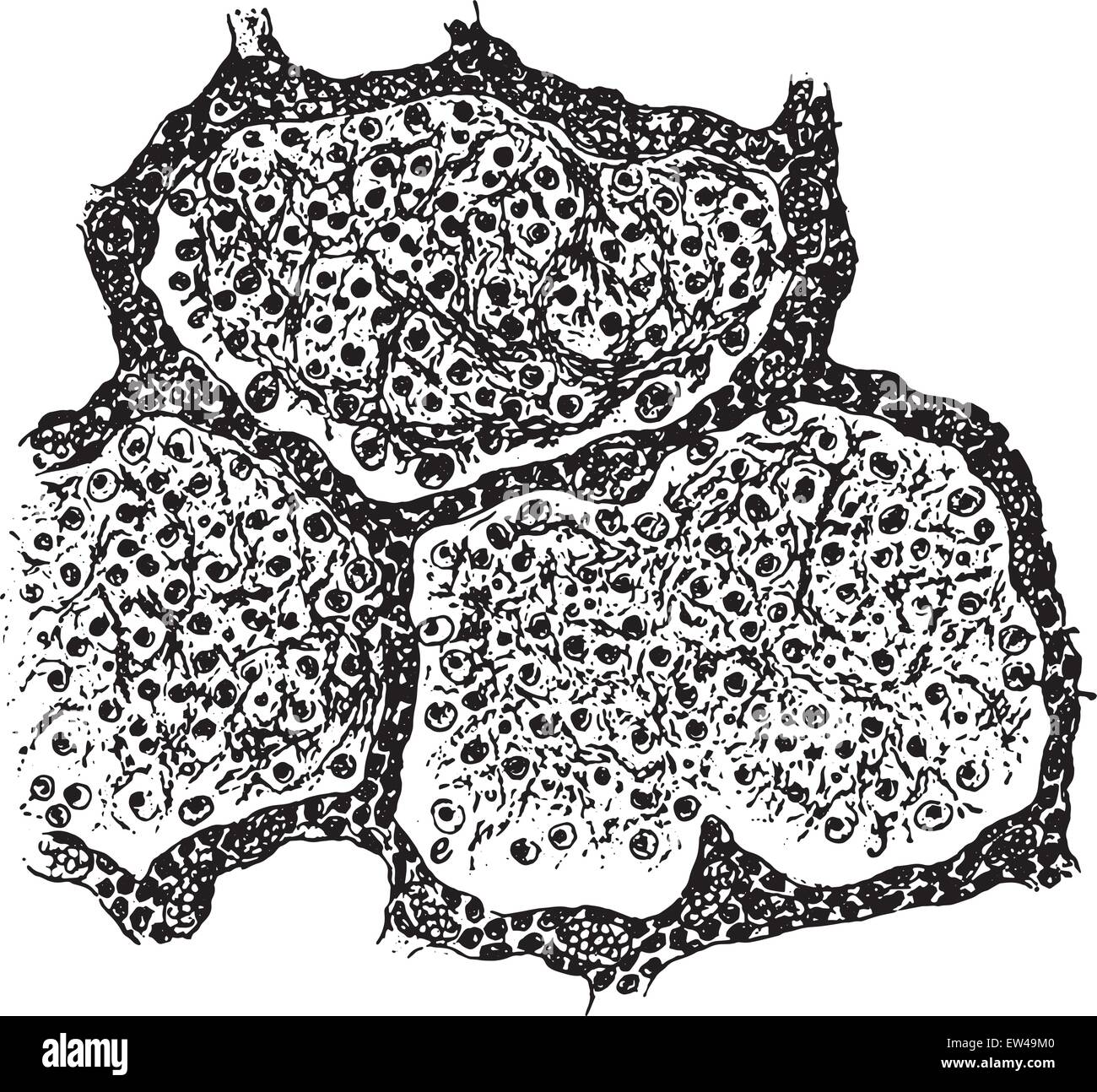 Trois alvéoles remplies d'un exsudat fibrineux, vintage engraved illustration. Illustration de Vecteur