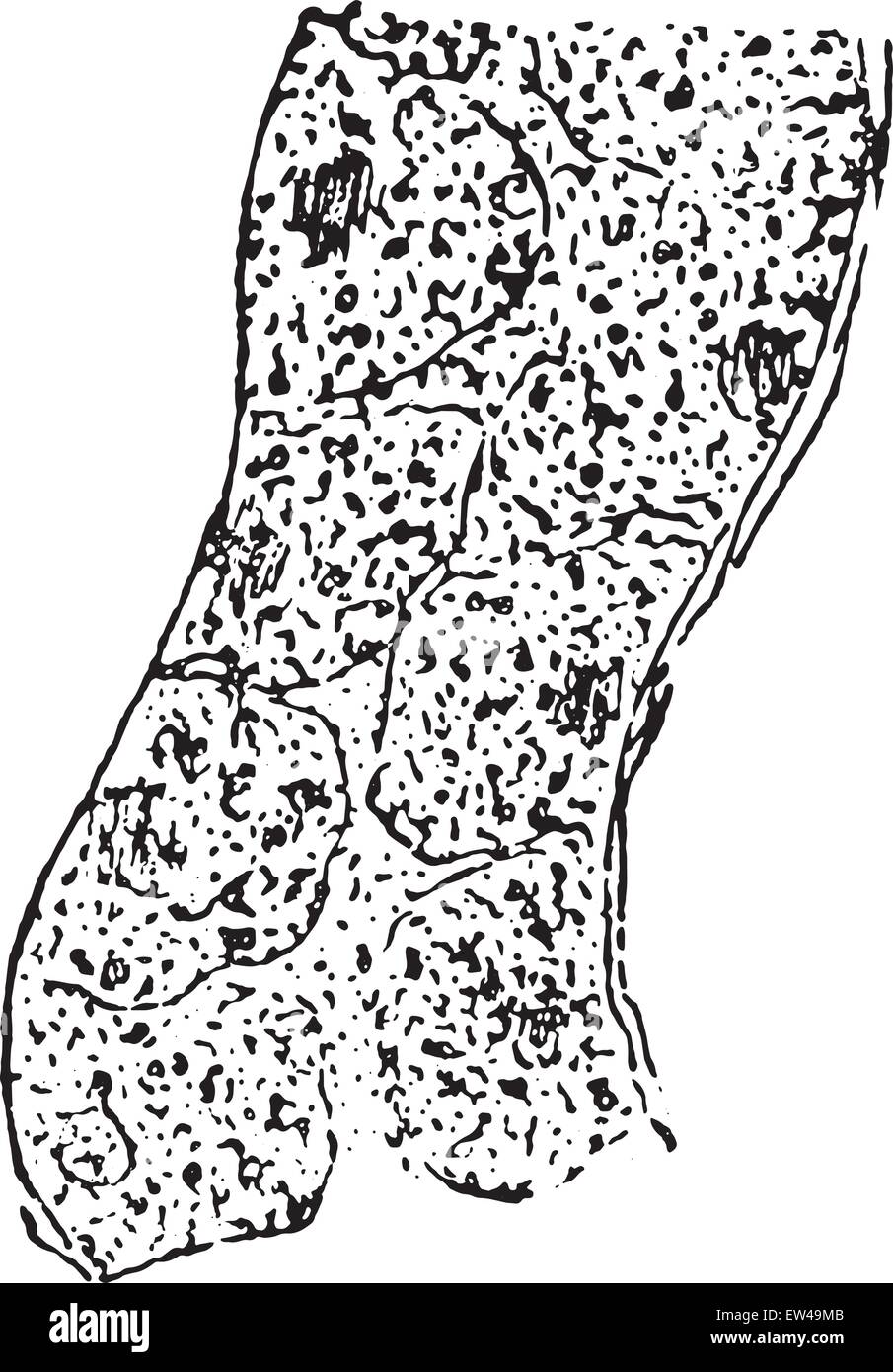 Dégénérescence granulaire de l'épithélium rénal, vintage engraved illustration. Illustration de Vecteur