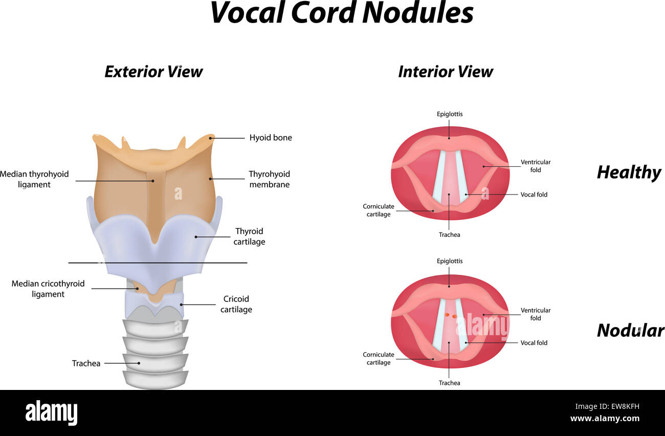 Nodules des cordes vocales Banque D'Images