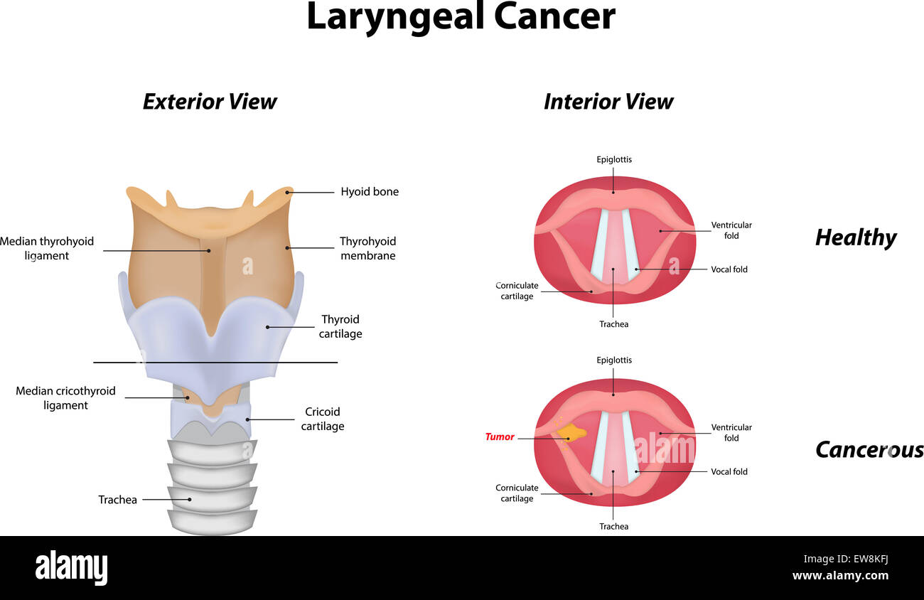 Cancer du larynx Banque D'Images