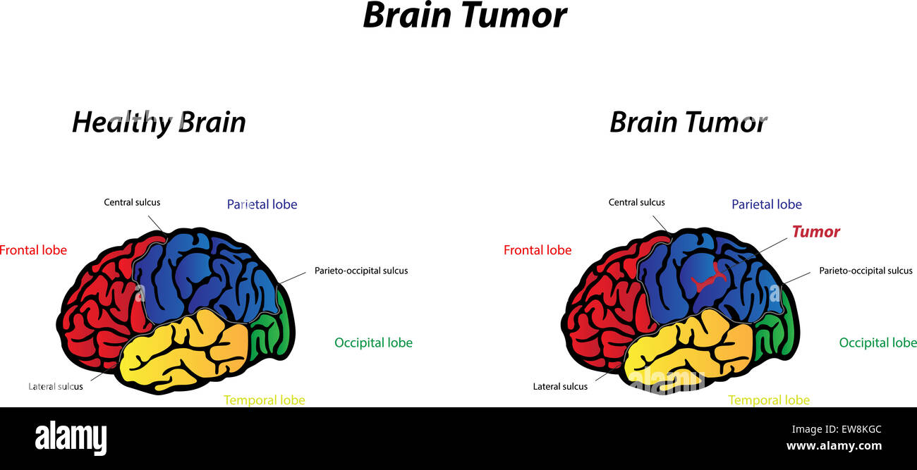Cancer du cerveau Banque de photographies et d’images à haute ...