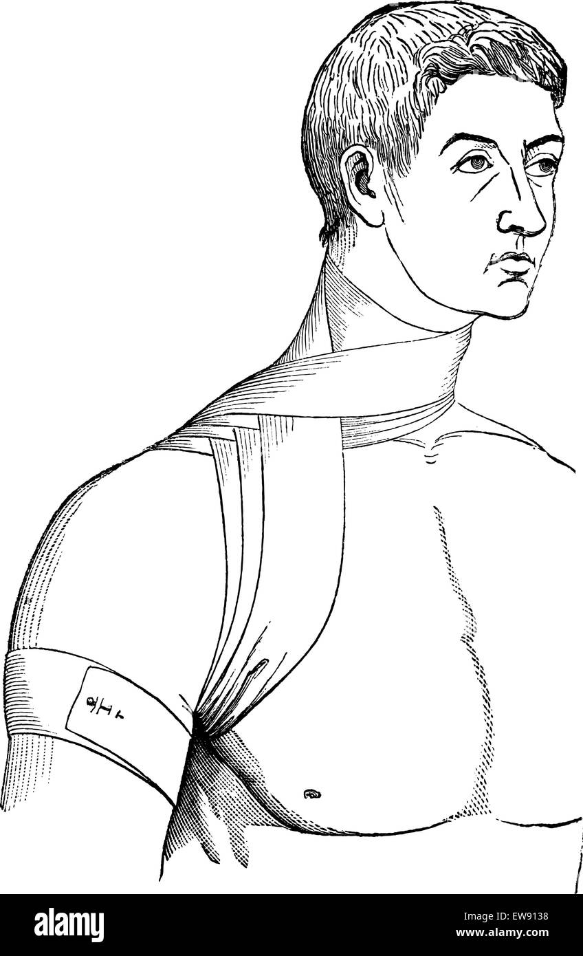 Croix de bandage le cou et l'aisselle, vintage engraved illustration. Magasin Pittoresque 1875. Illustration de Vecteur