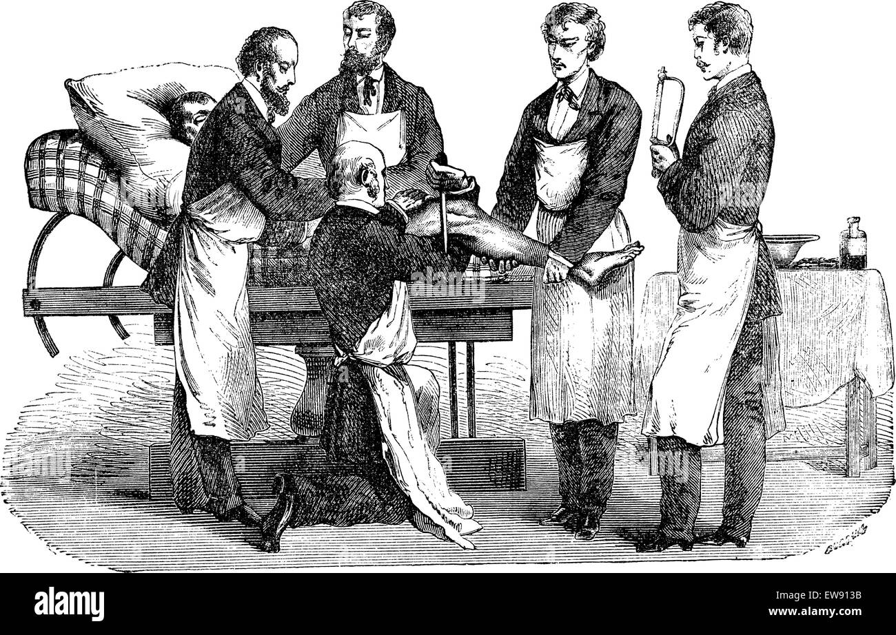 L'amputation de la cuisse. Positions du chirurgien et des assistants, vintage engraved illustration. Magasin Pittoresque 1875. Illustration de Vecteur