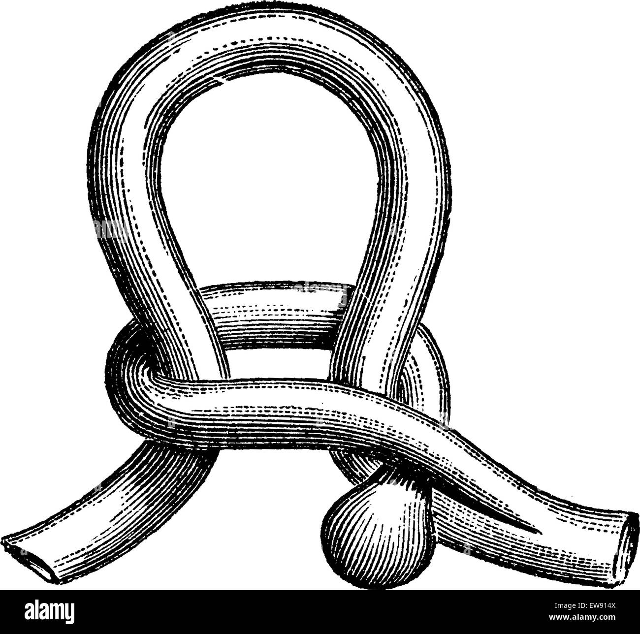 La strangulation du diverticule de l'intestin grêle, vintage engraved illustration. Dictionnaire de médecine habituelle par le Dr Labarth Illustration de Vecteur