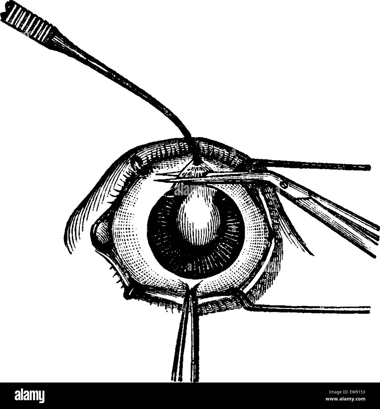 Iridectomy, montrant des pinces dépose une trappe de la partie supérieure de l'iris avant la chirurgie de la cataracte, vintage engraved illustra Illustration de Vecteur