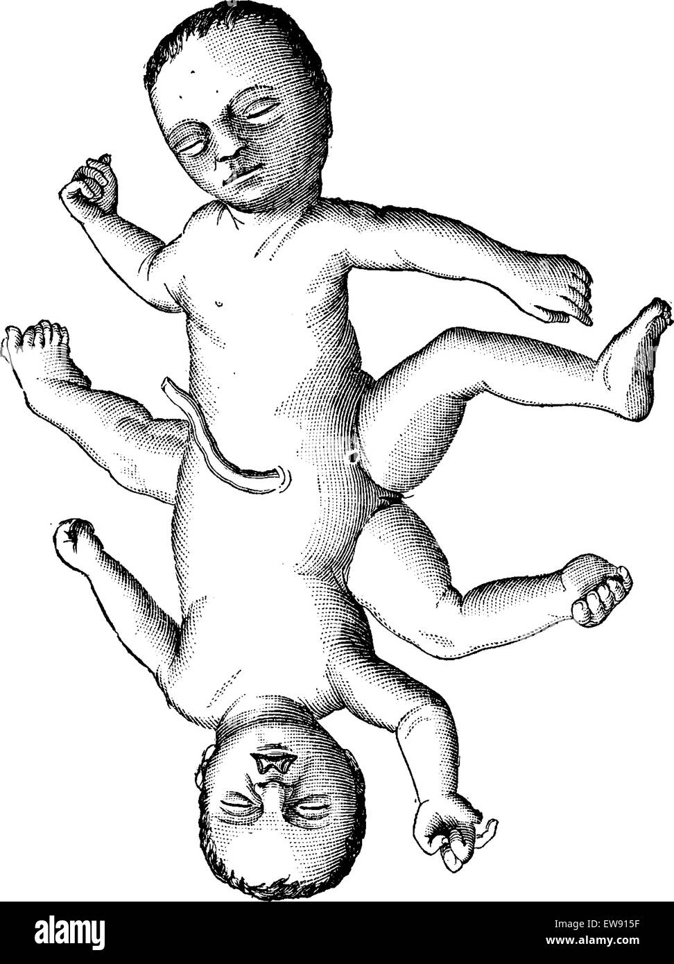 Ischiopagi ou jumeaux siamois united au bassin, vintage engraved illustration. Dictionnaire de médecine habituelle par le Dr Labarthe - 18 Illustration de Vecteur