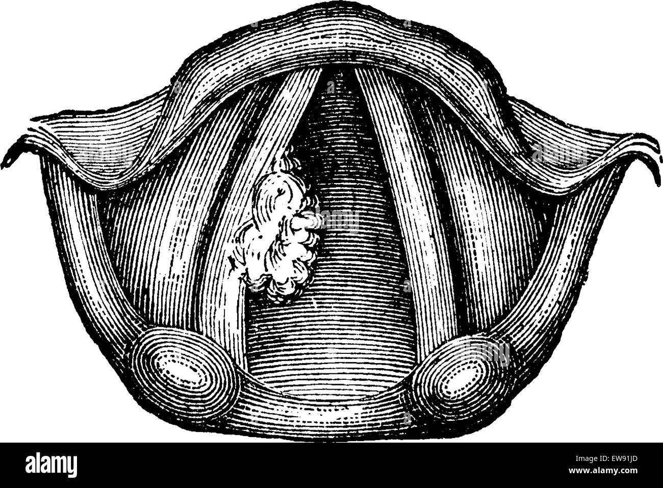 Papillome solitaire du larynx, vintage engraved illustration. Dictionnaire de médecine habituelle par le Dr Labarthe - 1885 Illustration de Vecteur