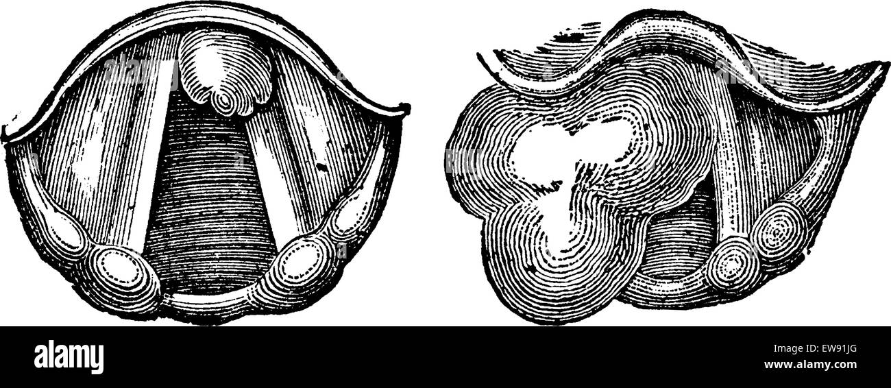 Les fibromes du larynx, vintage engraved illustration. Dictionnaire de médecine habituelle par le Dr Labarthe - 1885 Illustration de Vecteur