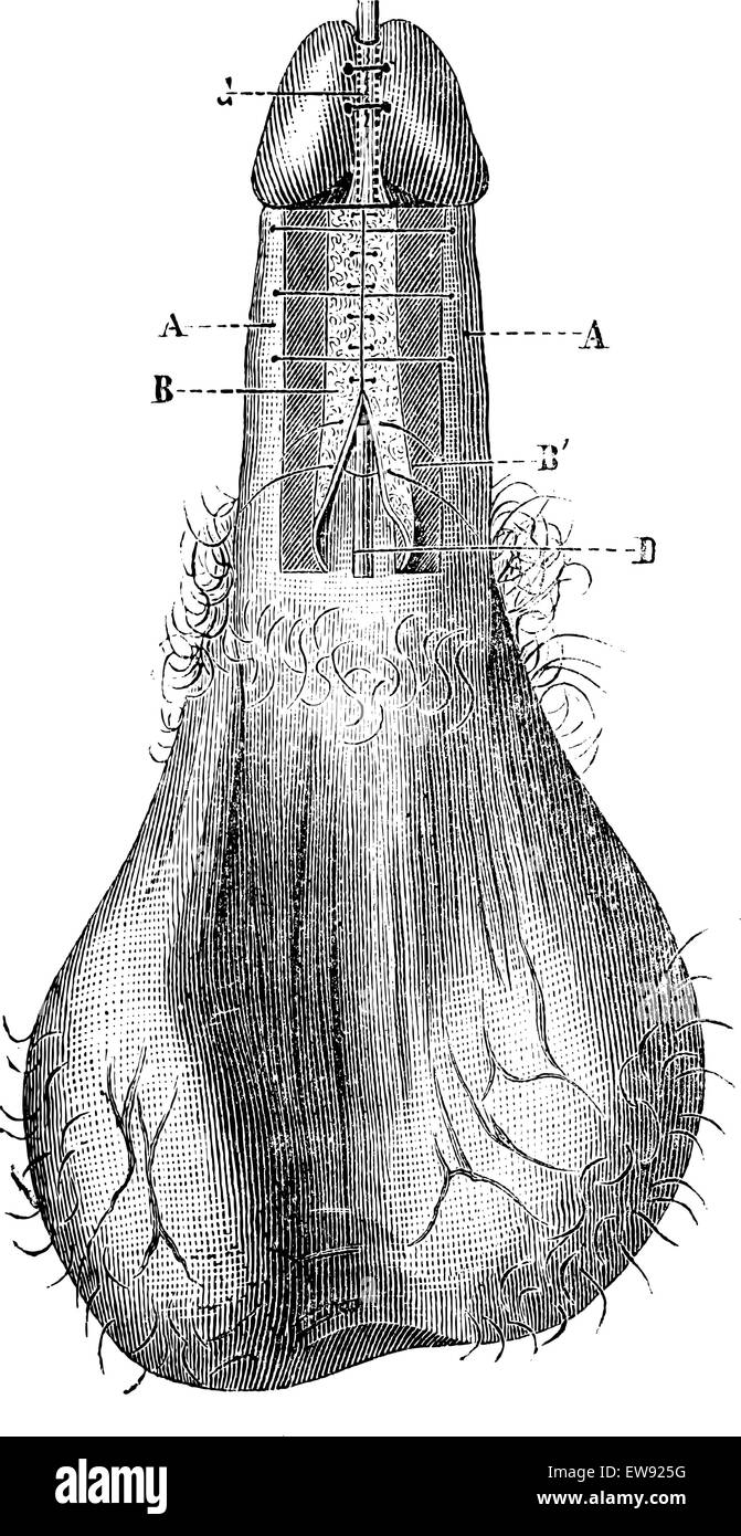 Fonctionnement de l'hypospadias (le processus de l'Duplay étudiera) vintage engraved illustration. Magasin Pittoresque 1875. Illustration de Vecteur