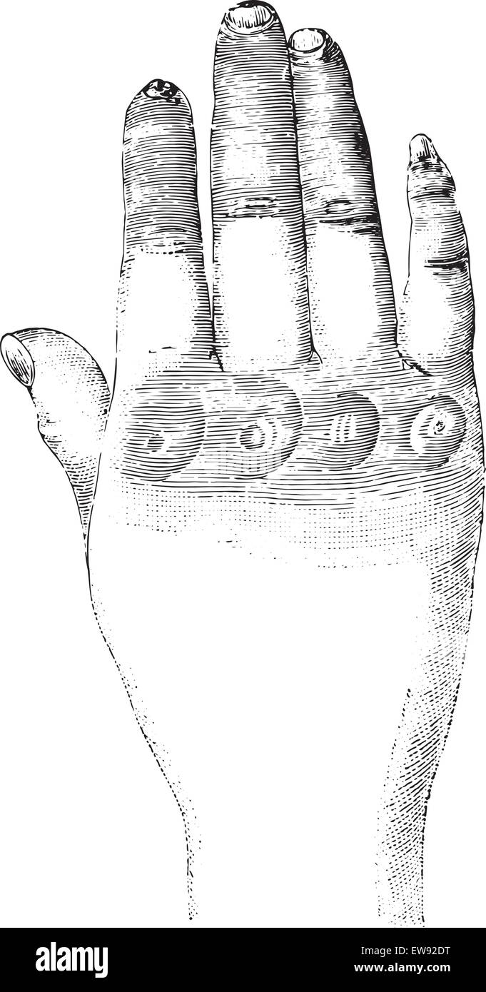 La sclérose en plaques de la main gauche (dorsale), vintage engraved illustration. Dictionnaire de médecine habituelle par le Dr Labarthe - 1885. Illustration de Vecteur