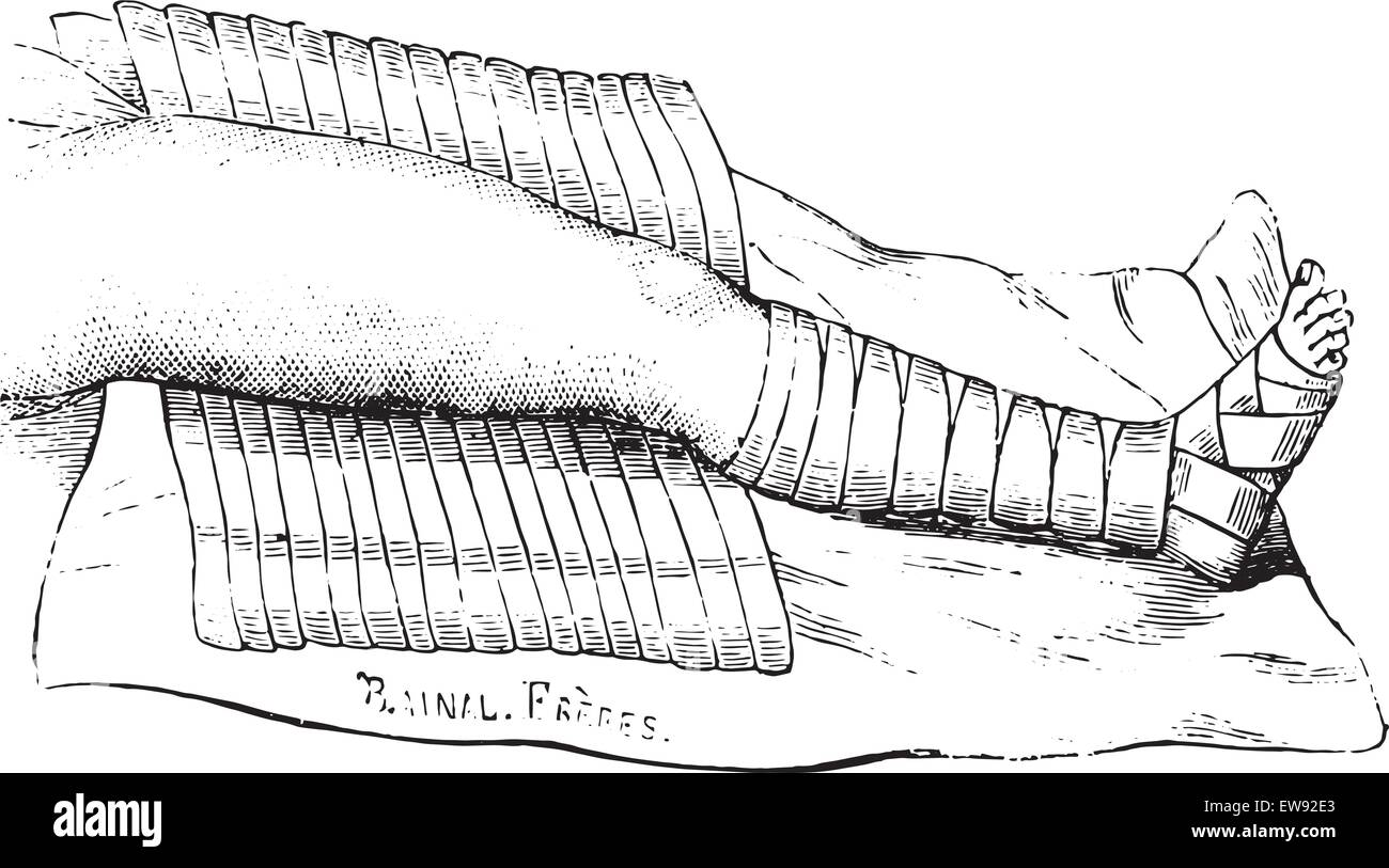 Scultet, appliqué la moitié de l'appareil illustration gravée vintage. Dictionnaire de médecine habituelle par le Dr Labarthe - 1885. Illustration de Vecteur