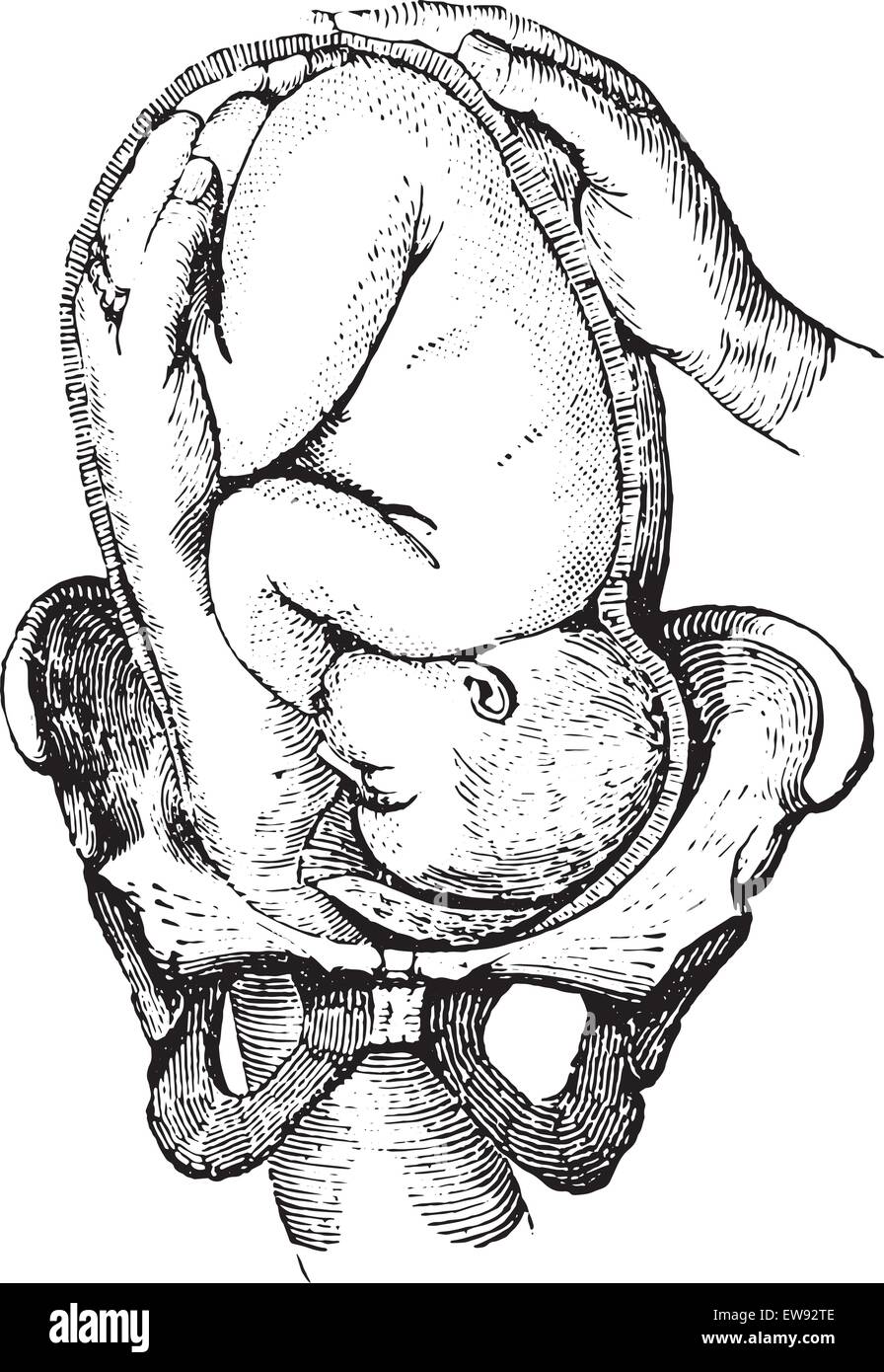 Version céphalique externe, comment faire les pieds de façon à caresser l'enfant sur le plan précédent, vintage engraved illustration. U Illustration de Vecteur