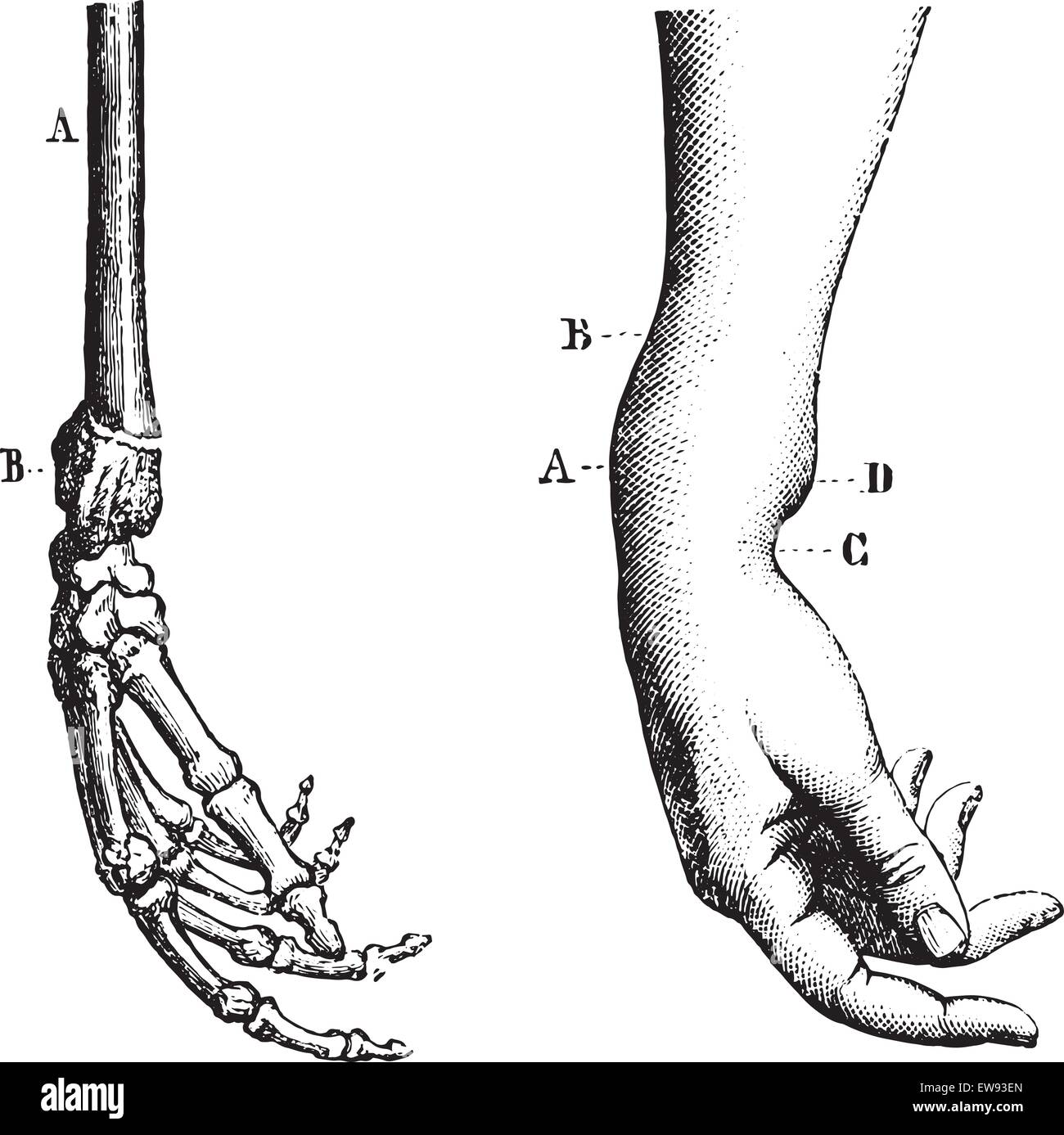 Fracture de l'extrémité inférieure du radius, vintage engraved illustration. Dictionnaire de médecine habituelle par le Dr Labarthe - 1885. Illustration de Vecteur