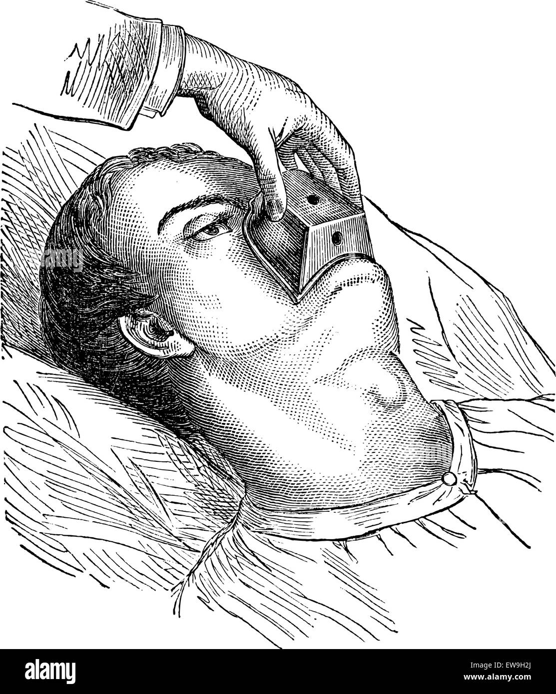 Application d'un cône de chloroforme, vintage engraved illustration. Magasin Pittoresque 1875. Illustration de Vecteur