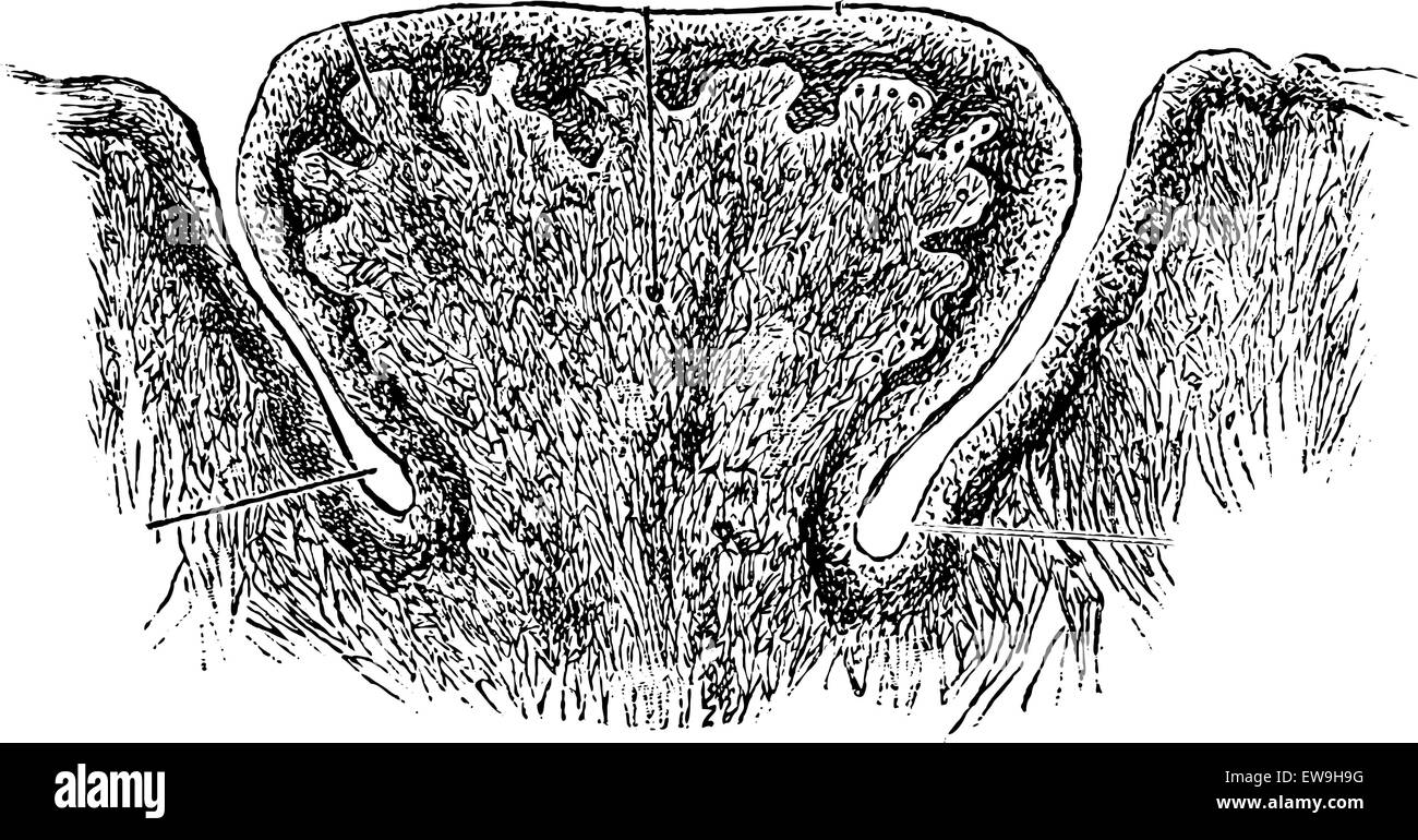 Papille Vallate de la langue humaine, à fort agrandissement, vintage engraved illustration. Dictionnaire de médecine habituelle par le Dr Labar Illustration de Vecteur