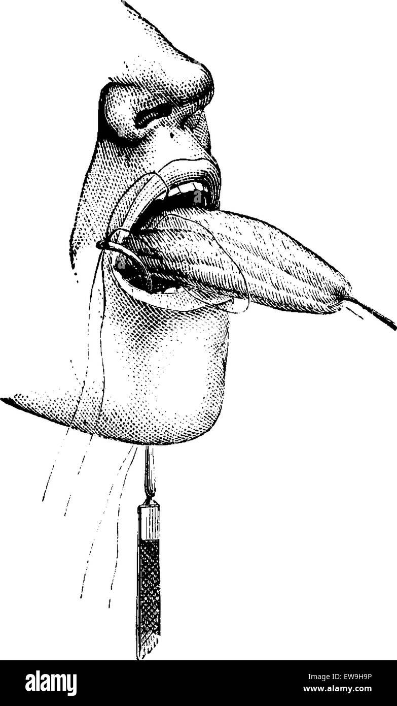 Amputation partielle de la langue à l'aide de ligatures, vintage engraved illustration. Dictionnaire de médecine habituelle par le Dr Labarthe - 1885 Illustration de Vecteur