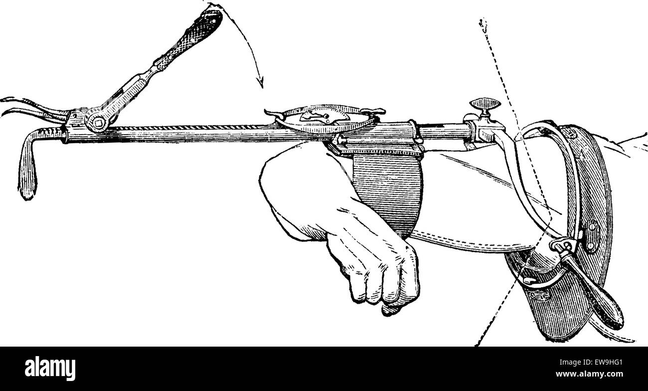 Appareil Charriere pour réduire les déplacements de l'épaule récents ou anciens, vintage engraved illustration. Dictionnaire de médecine habituelle Illustration de Vecteur