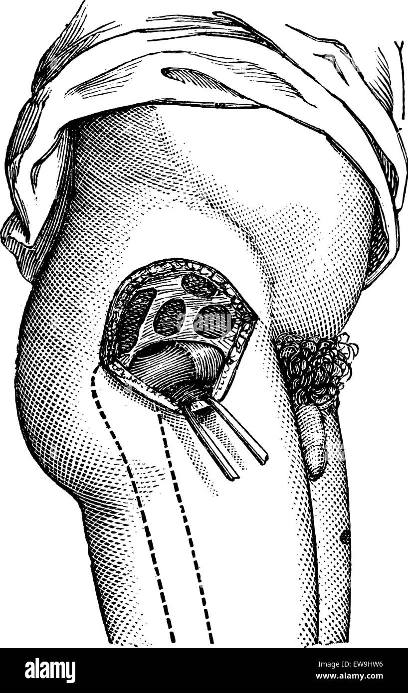 La hanche ouverte par l'extérieur, pour montrer le col du fémur, vintage engraved illustration. Magasin Pittoresque 1875. Illustration de Vecteur